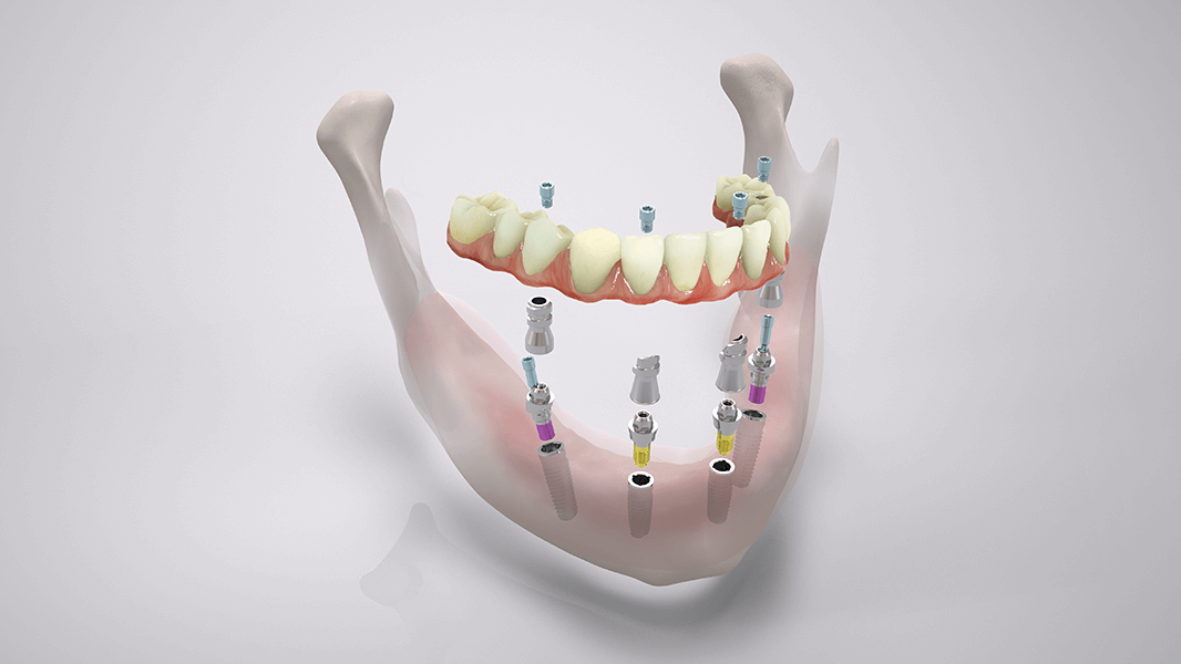 COMFOUR System screw-retained bridge