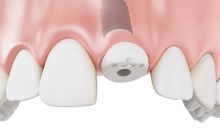 toothshaped healing caps made of the tissue-friendly material PEEK screw-retained on the implant with occlusal scan marking and buccal marking.