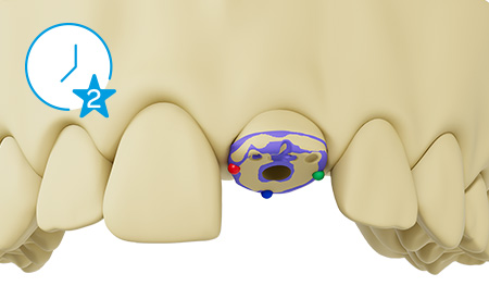 PEEK healing cap screw-retained on the implant with occlusal scan marking and buccal marking. Matching the scan data with the CAD library data. Predefined emergence profile transferred directly into the CAD design. Blue clock icon with star and number one in the upper left hand corner of the image indicating time saving benefits in this step..